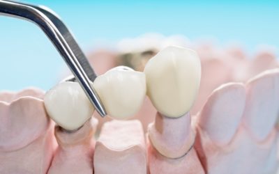 Dental Bridge Restoration: Your Answer To Tooth Loss
